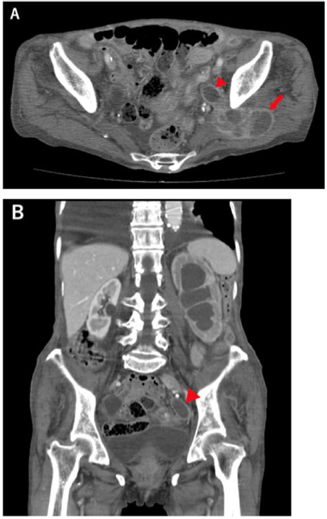 Abdominal Contrast Enhanced Computed Tomography A Axial View And B