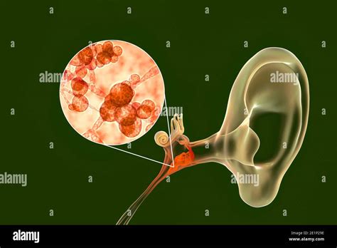 Infected Ear Drum Hi Res Stock Photography And Images Alamy