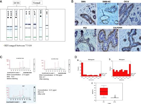 Expression Profile Of Myoepithelial Cells In DCIS Do They C