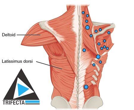 Knots And Trigger Points How To Untie The Knot And Be Active In