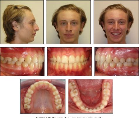 Figure 5 From Treatment Of Class Ii Division 2 Malocclusion Using The Forsus Fatigue Resistance