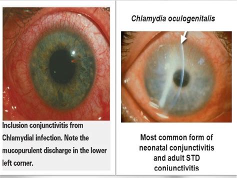 Chlamydia Conjunctivitis