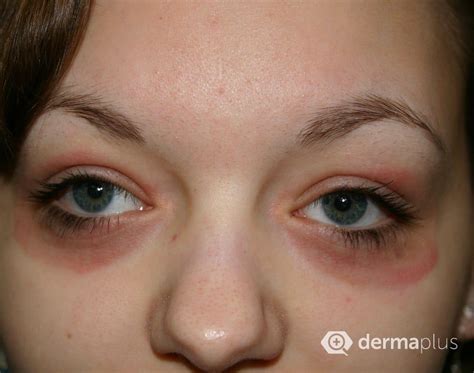 Juckreiz Rötungen und Schwellungen am Auge derma plus