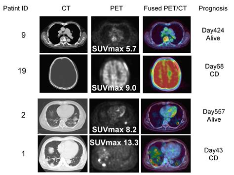 Impact Of Maximum Standardized Uptake Value SUVmax Evaluated By 18