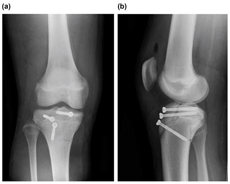 Tibial Tuberosity Avulsion Fracture Radiology Referen