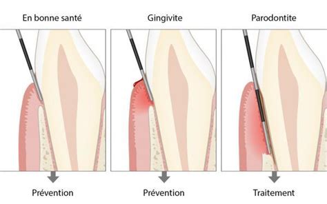 Diagnostic De La Parodontite En Savoir Plus Periodontal Fr