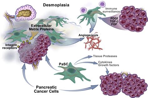 Desmoplasia Of Pancreatic Ductal Adenocarcinoma Clinical