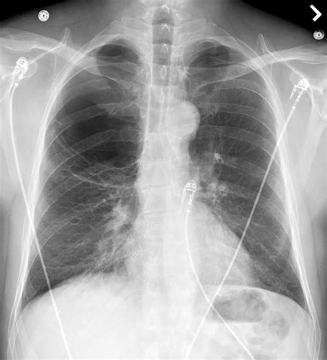 Chest Radiograph Pa View Showing Right Upper Zonal Area Of Increased