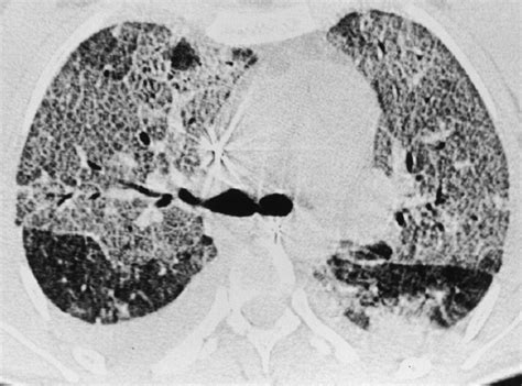 Pulmonary Edema CT Scan