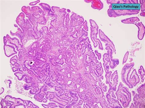 Qiao S Pathology Papillary Adenoma Of The Gallbladder Intracystic