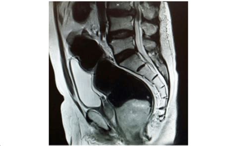 Sagittal T2 Weighted Magnetic Resonance Image Shows Hyperintense Areas