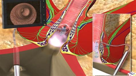 Vaaft Vs Lift Best Anal Fistula Treatment Dr Raviram S
