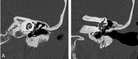 Pars Tensa Cholesteatoma A Coronal Hrct Scan At The Level Of The