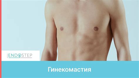 Лечение гинекомастии - YouTube