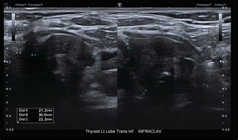 Thyroid US‐ 21 × 30 × 22 mm irregular, hypoechoic nodule with ...