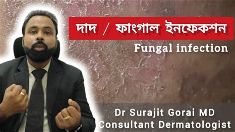 Fungal Infection Ringworm Dr Surajit Gorai Md