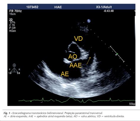 Scielo Brasil Ap Ndice Atrial Esquerdo Imagem Ecocardiogr Fica