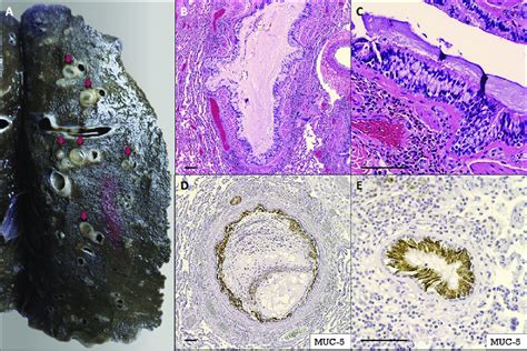 Mucous Plugs Obstructing Intrapulmonary Bronchi A Dilated Bronchi