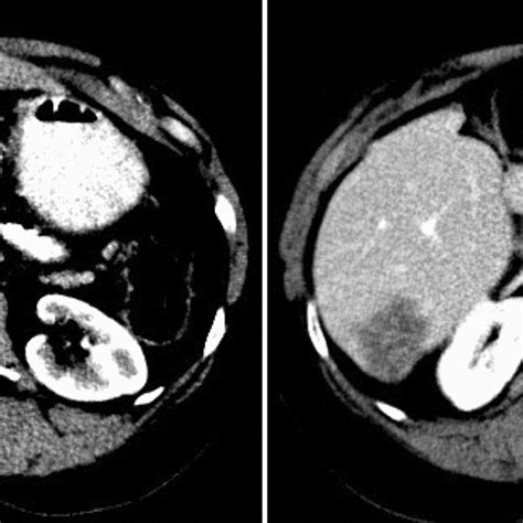 Contrast Enhanced Computed Tomography Ct Scan Of The Liver Of Patient