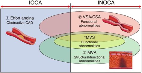 JCS CVIT JCC 2023 Guideline Focused Update On Diagnosis And Treatment