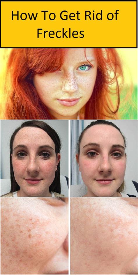 How To Get Rid Of Freckles Getting Rid Of Freckles Chemical Peel Intense Exfoliation