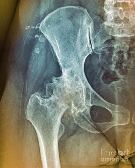 Osteoarthritis Of The Hip Photograph By Zephyr Science Photo Library