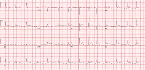 Atrial Flutter Rhythm Strip