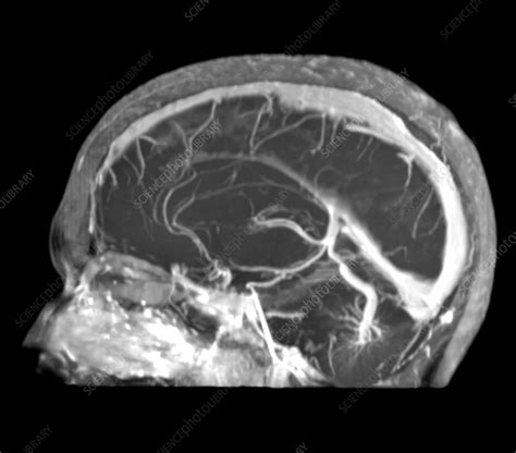 Large Developmental Venous Anomaly Mri Stock Image C