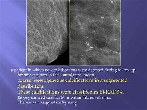 PPT Breast Calcifications Differential Diagnosis And BIRADS