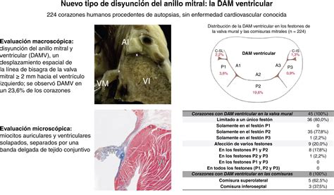 Descripci N Y Prevalencia De La Disyunci N Del Anillo Mitral Y El