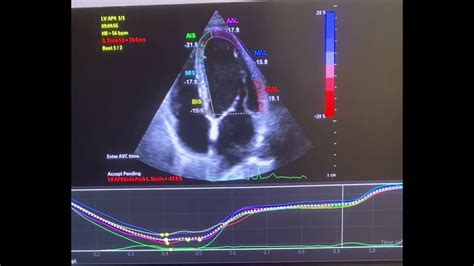 How To Do Strain Echocardiogram Youtube