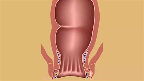 Fast Five Quiz Anal Fissures And Fistulas United States Head Topics