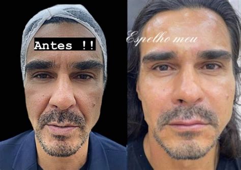 Andr Gon Alves Faz Harmoniza O Facial Veja Antes E Depois