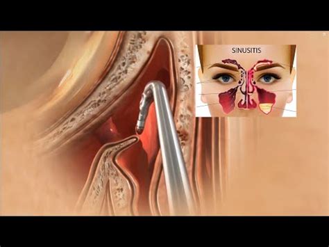 Sinus Surgery D Animation Sinusitis Treatment Sinus Operation