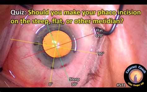 Cataract Quiz Where Should You Make The Incision Cataract Coach™