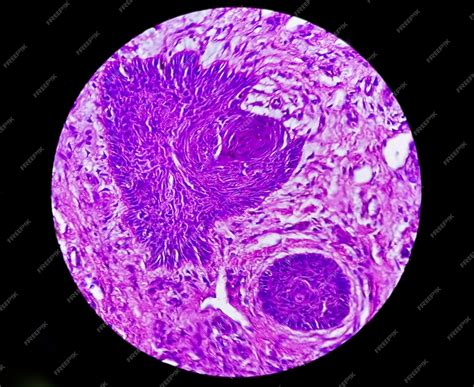 Biopsia De Piel Bajo Microscopía Sugestiva De Carcinoma De Células