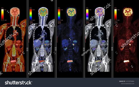 Positron Emission Tomography Pet Ct Scan Stock Illustration