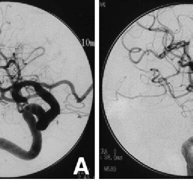 A Follow Up Right Carotid Angiogram Obtained Months After The