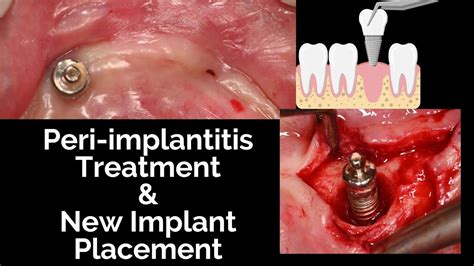 Peri Implantitis Tedavisi Ve Mplant Yerle Tirilmesi Periimplantitis