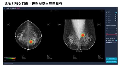 식약처 ‘유방암영상검출·진단보조 소프트웨어 제14호 혁신의료기기로 지정 더케이헬스