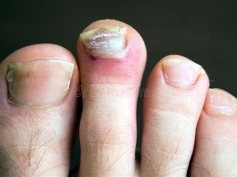 Chronic Ingrown Toenail Photos Free Royalty Free Stock Photos From