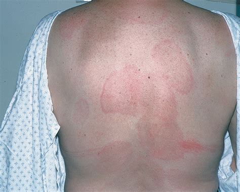 Erythema Multiforme Diseases And Conditions 5minuteconsult