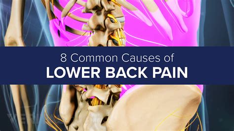 Slideshow: 8 Common Causes of Lower Back Pain | Spine-health