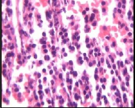 Histopathology Of The Biopsy From The Tumor Malignant Neoplastic Cells