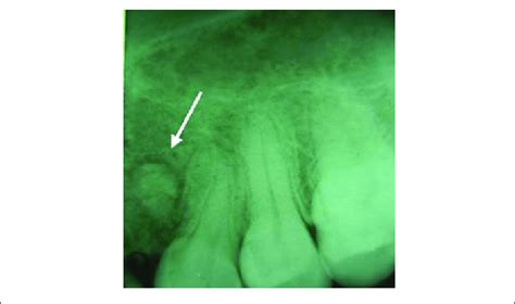 Radiopaque Lesion In The Maxilla Periapical Radiographic Image In The