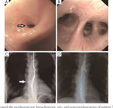 Figure 2 From Surgical Management Of Acquired Tracheo Bronchoesophageal