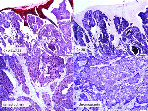 The Neoplastic Cells Are Positive For Ck Ae Ae Ck Synaptophysin