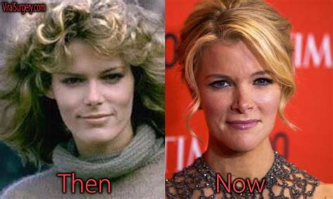 Megyn Kelly Plastic Surgery Before And After Botox Pictures