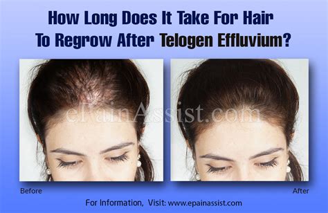 The Different Causes Of Hair Loss Telogen Effluvium Justinboey