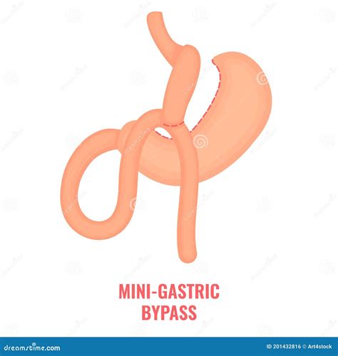 Mini Gastric Bypass Bariatric Surgery Weight Loss Infographics Stock